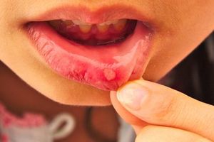 Bị tưa miệng, nhiệt miệng chữa thế nào?