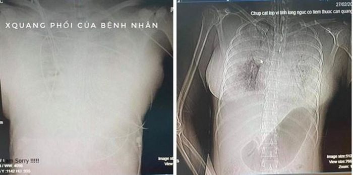 Bệnh nhân tử vong bất thường sau khi tiêm filler làm đầy ngực